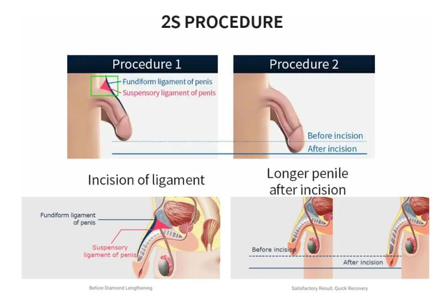 1 Penis Enlargement Surgery in Korea Seoul Proud Urology Clinic